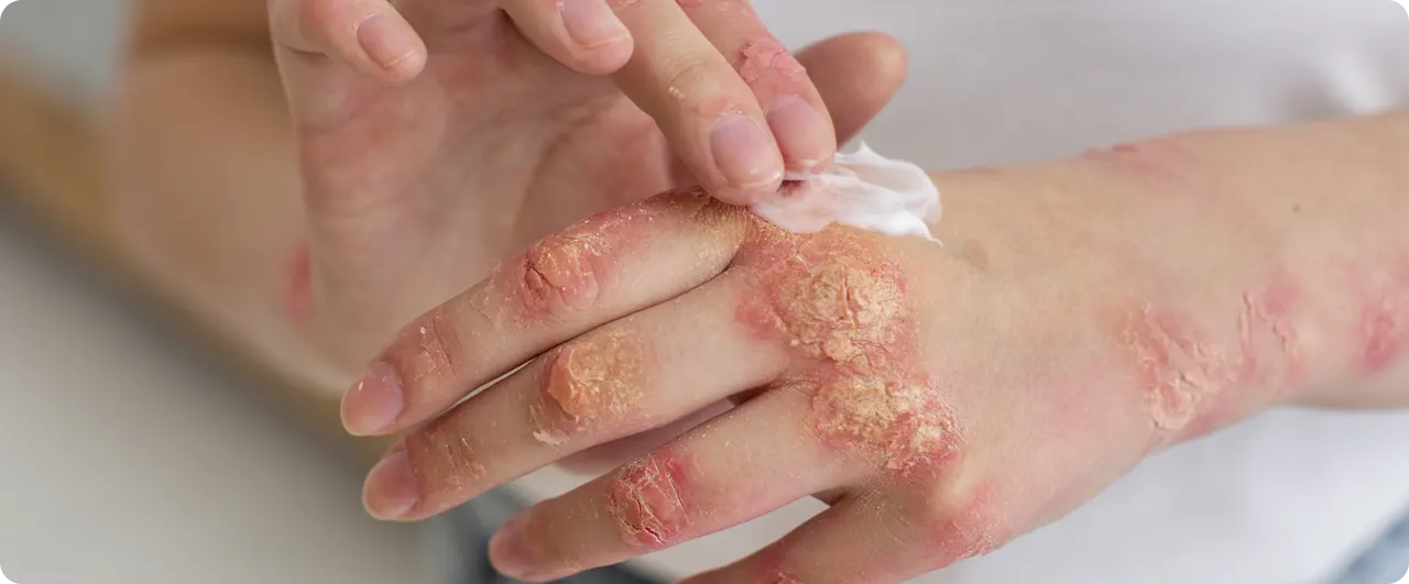 ¿Cómo prevenir la fiebre del mono? | ¿Es contagioso el herpes zóster? 