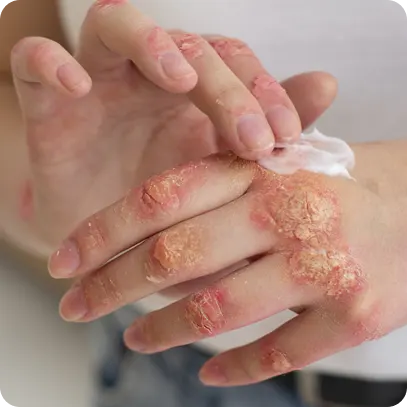 ¿Cómo prevenir la fiebre del mono? | ¿Es contagioso el herpes zóster? ¿Cómo prevenir la fiebre del mono? | ¿Es contagioso el herpes zóster?