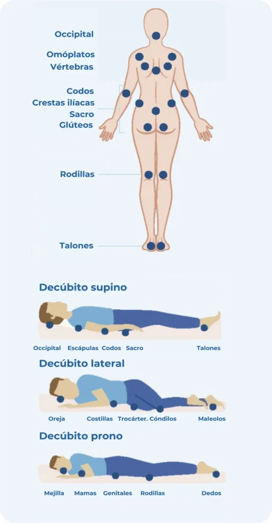 Áreas de mayor riesgo de úlceras por presión