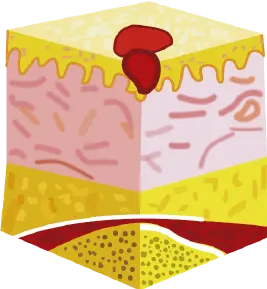 Estadio II: Pérdida parcial del grosor de la piel 