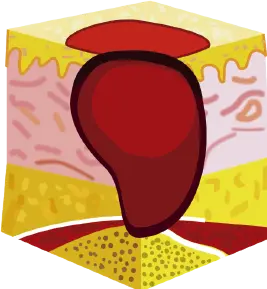 Estadio IV: Pérdida total del tejido con exposición de hueso, tendón o músculo